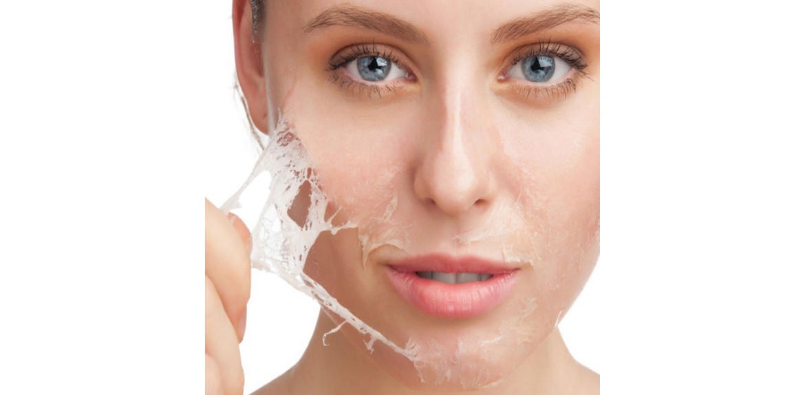 Kimyasal Peeling
